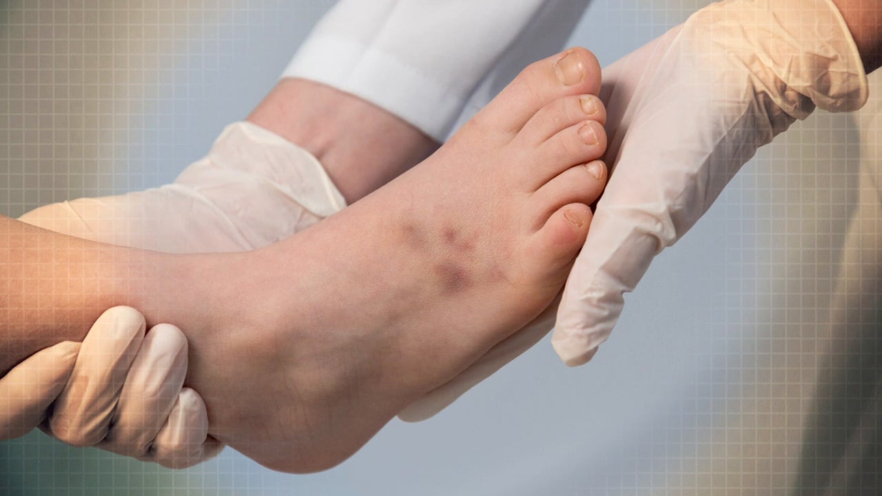 Miksi toistuvat mustelmat voivat viitata C-vitamiinin puutteeseen