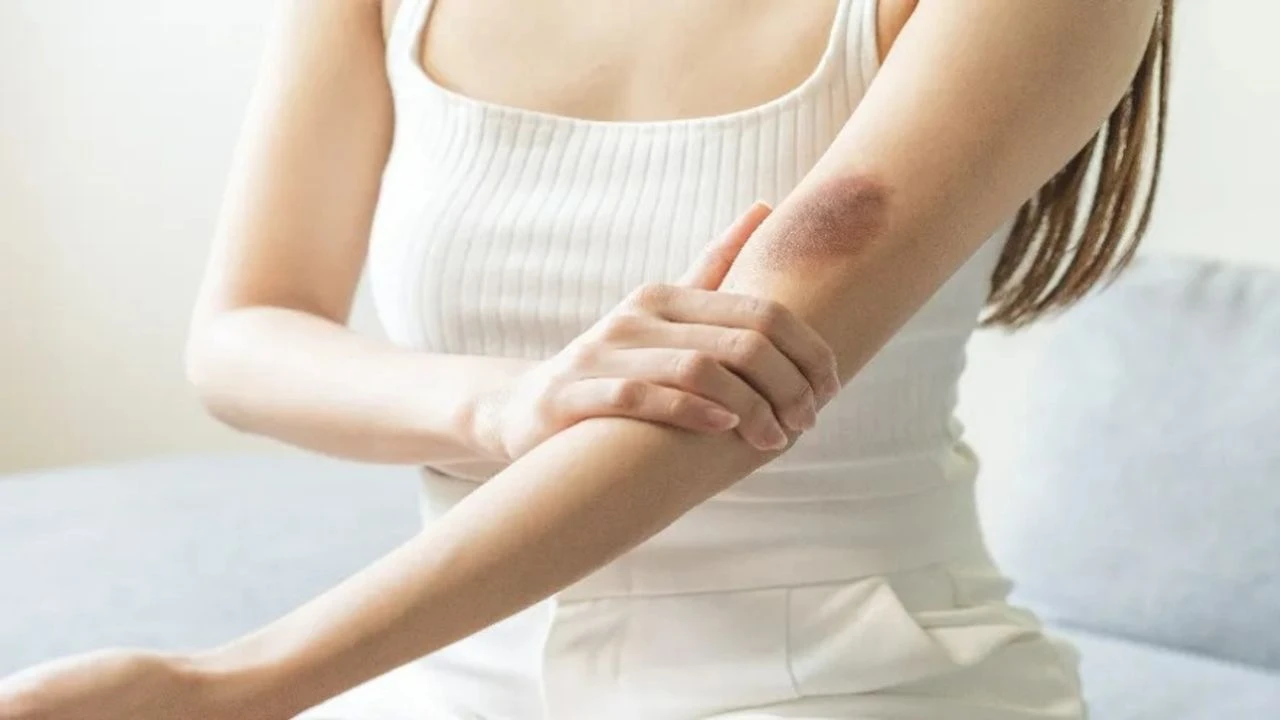 Miksi toistuvat mustelmat voivat viitata C-vitamiinin puutteeseen